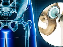 robotic hip replacement surgery in bhopal